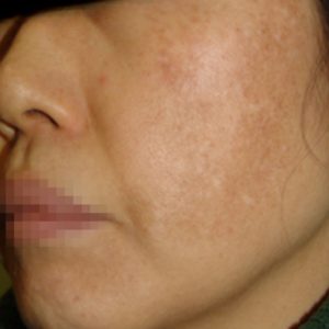 肝斑 Melasma