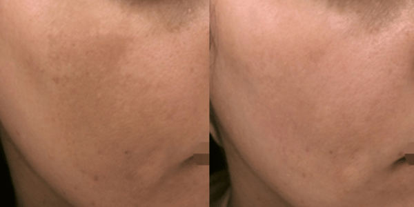 Melasma (600 x 300 像素) (11)