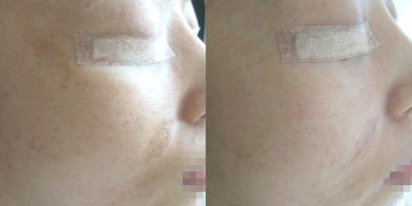 Melasma (600 x 300 像素) (4)