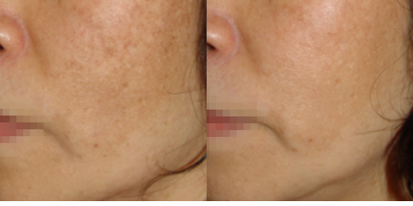 Melasma (600 x 300 像素) (6)