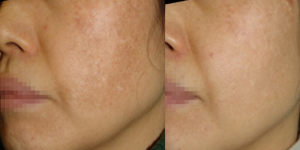 Melasma (600 x 300 像素) (7)