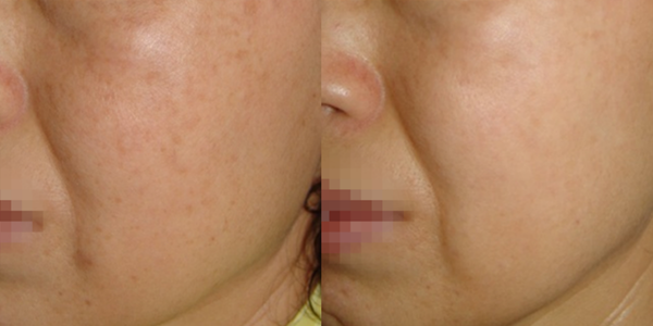 Melasma (600 x 300 像素) (8)