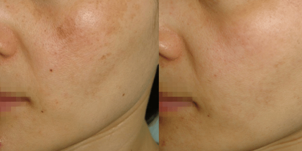 Melasma (600 x 300 像素) (9)