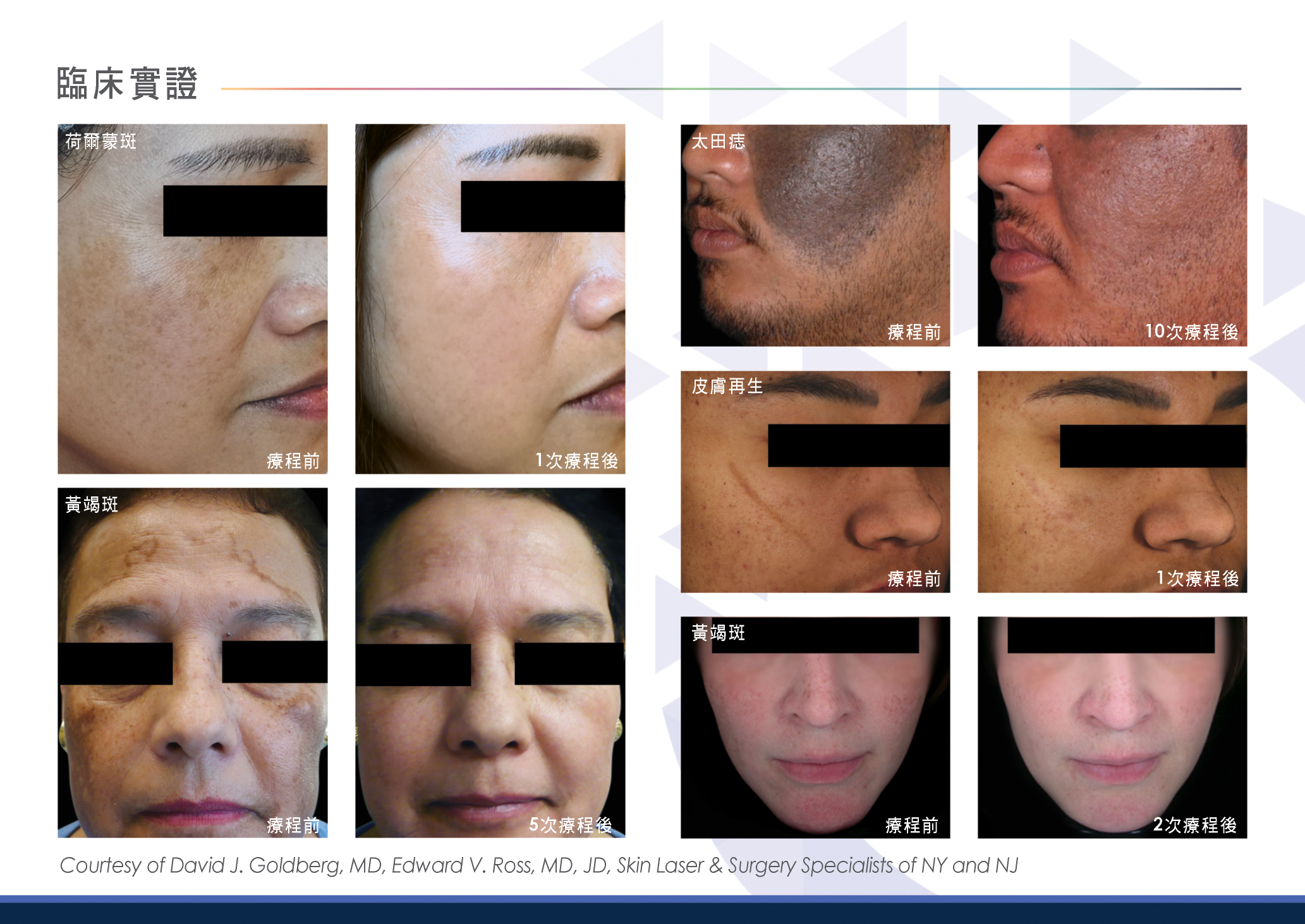 Pico Laser Treatment before and after