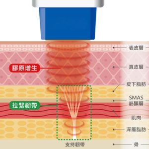 透過熱能激活膠原蛋白，達到重塑輪廓、撫平皺紋的顯著效果
