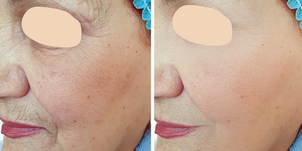 RF Treatment Before & After