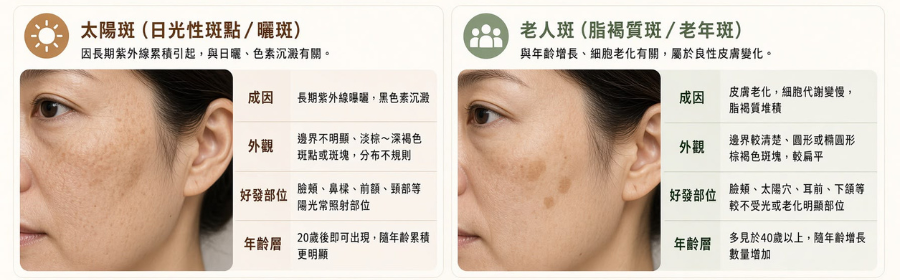 太陽斑與老人斑，您分得清嗎？